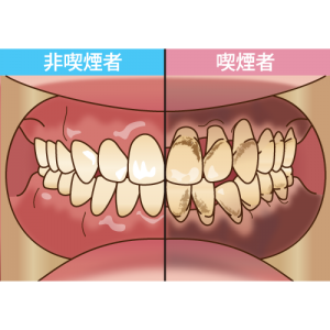 歯茎が黒ずんでしまう理由