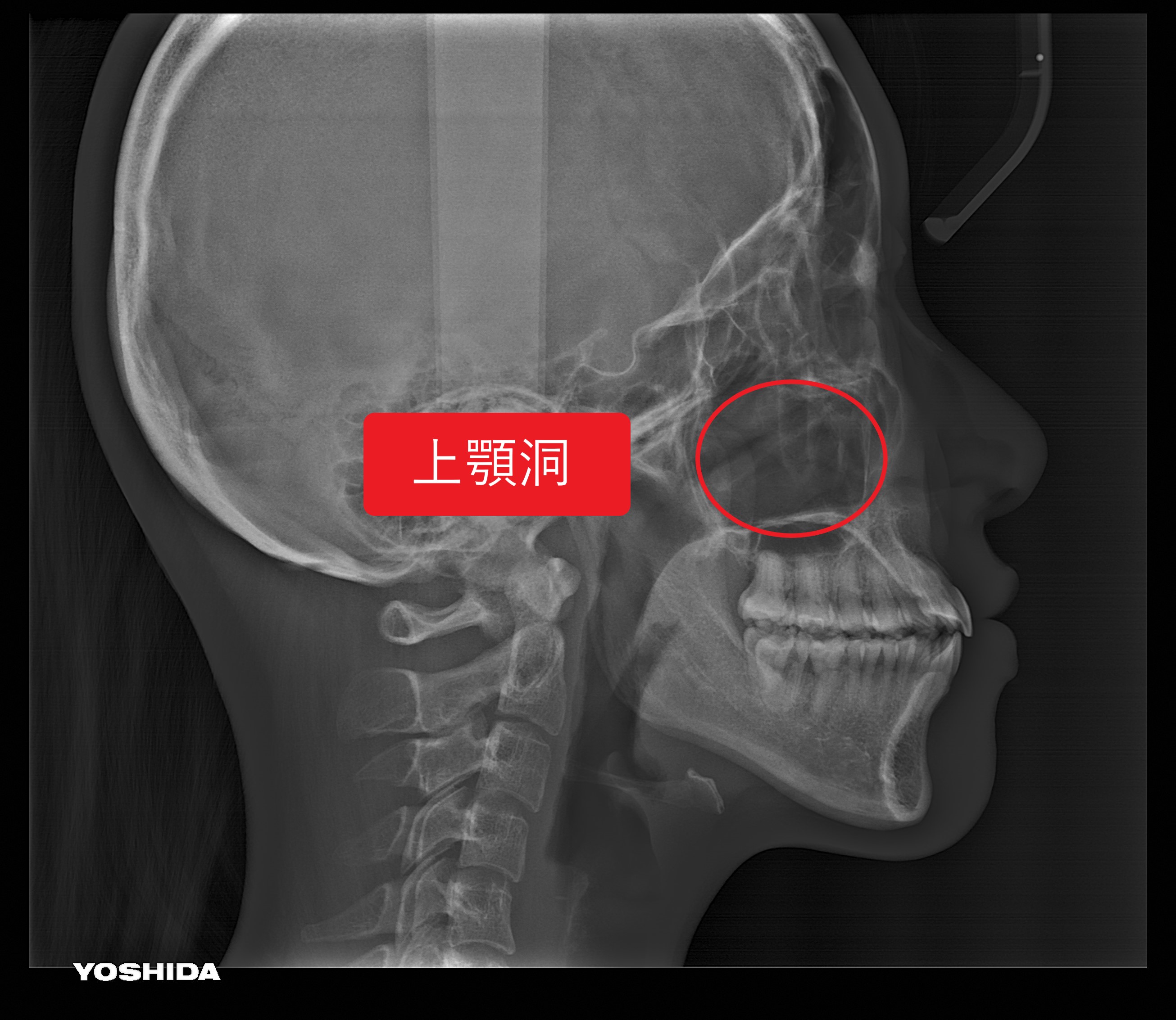 耳鼻科だけじゃない!歯科治療でも関係のある「上顎洞」って何?|恵優会 歯科ブログ|医療法人 恵優会